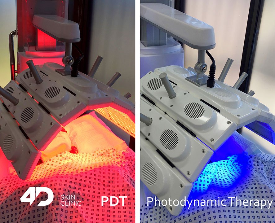 PDT Photodynamic Therapy