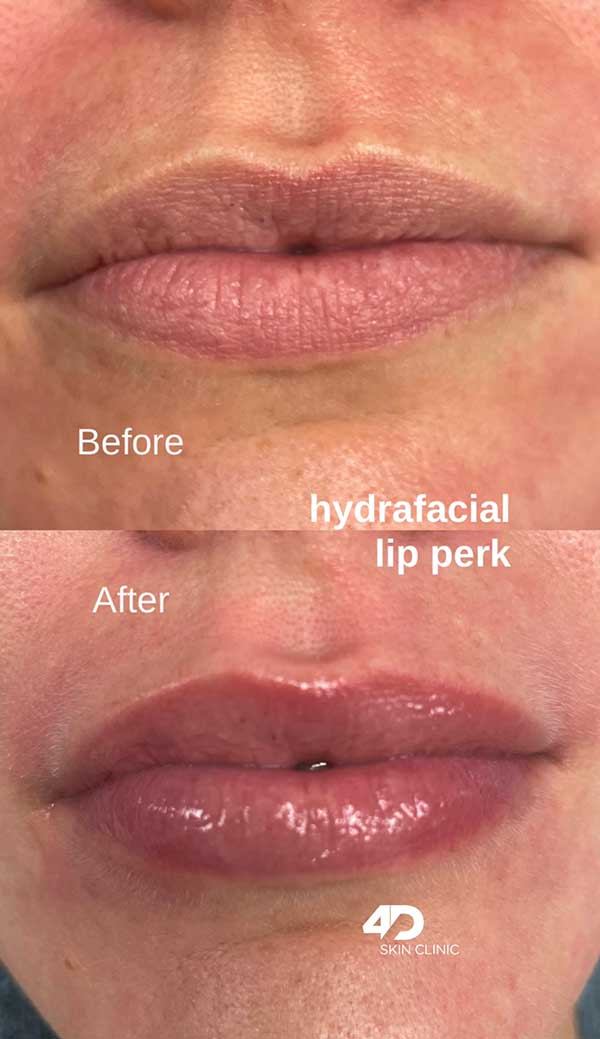 Hydrafacial Before & After